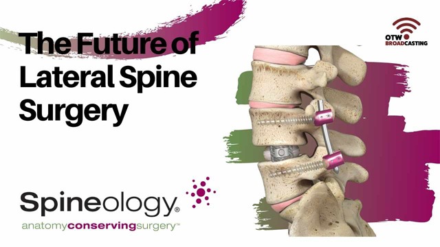 The Future of Lateral Spine Surgery